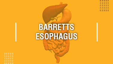 Peers Alley Media: Barretts Esophagus