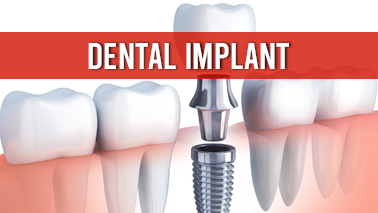 Peers Alley Media: Dental Implant