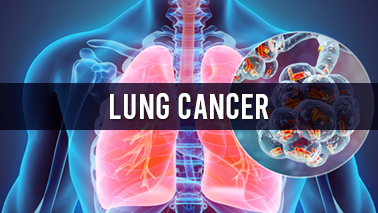 Peers Alley Media: Lung Cancer