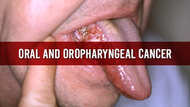 Peers Alley Media: Oral and Oropharyngeal Cancer