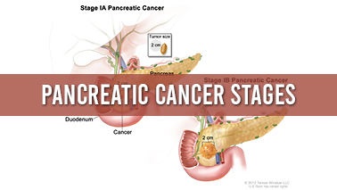 Peers Alley Media: Pancreatic Cancer Stages